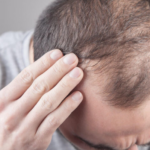 Saç Ekimi Öncesi Saç Dökülmesinin Bilimsel Analizi